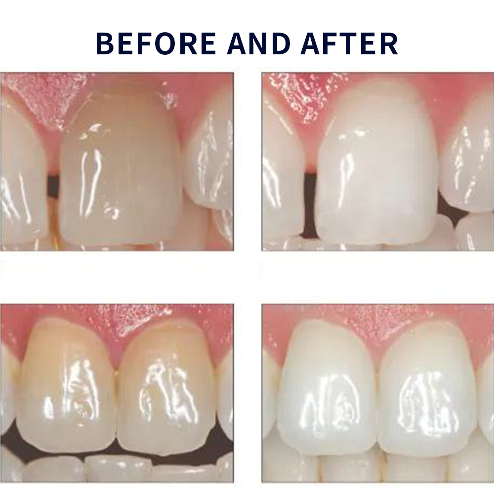 Opalescence Whitening 20% PF 2 - Teeth Whitening At Home Kit review and price