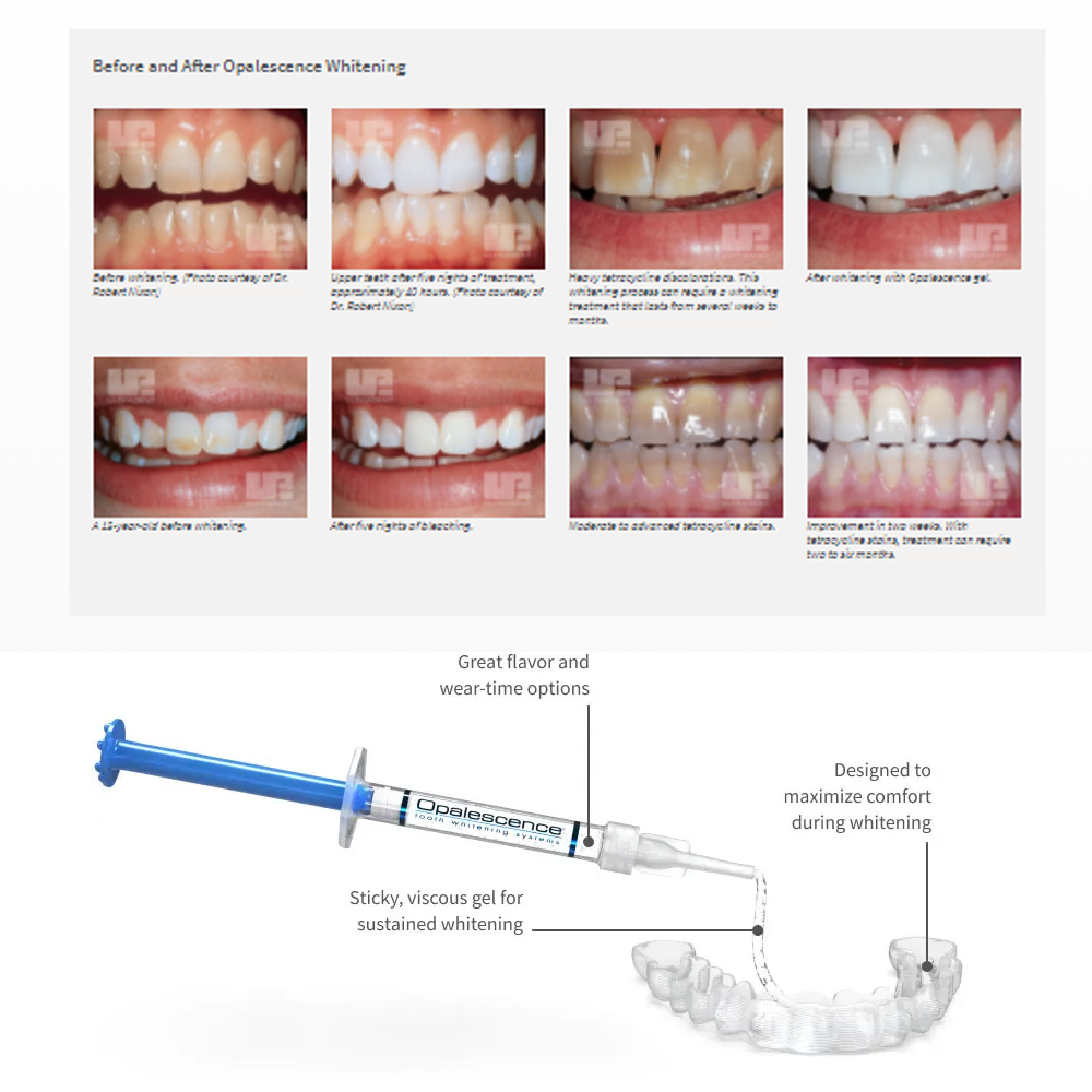Opalescence Whitening 20% PF 2 - Teeth Whitening At Home Kit review and price
