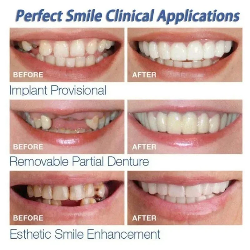 Snap-on Veneer Teeth Kit Adjus - Teeth Whitening Veneers review and price