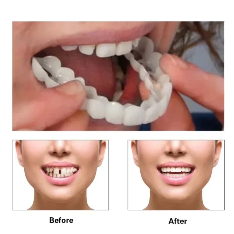 Snap-on Veneer Teeth Kit Adjus - Teeth Whitening Veneers review and price